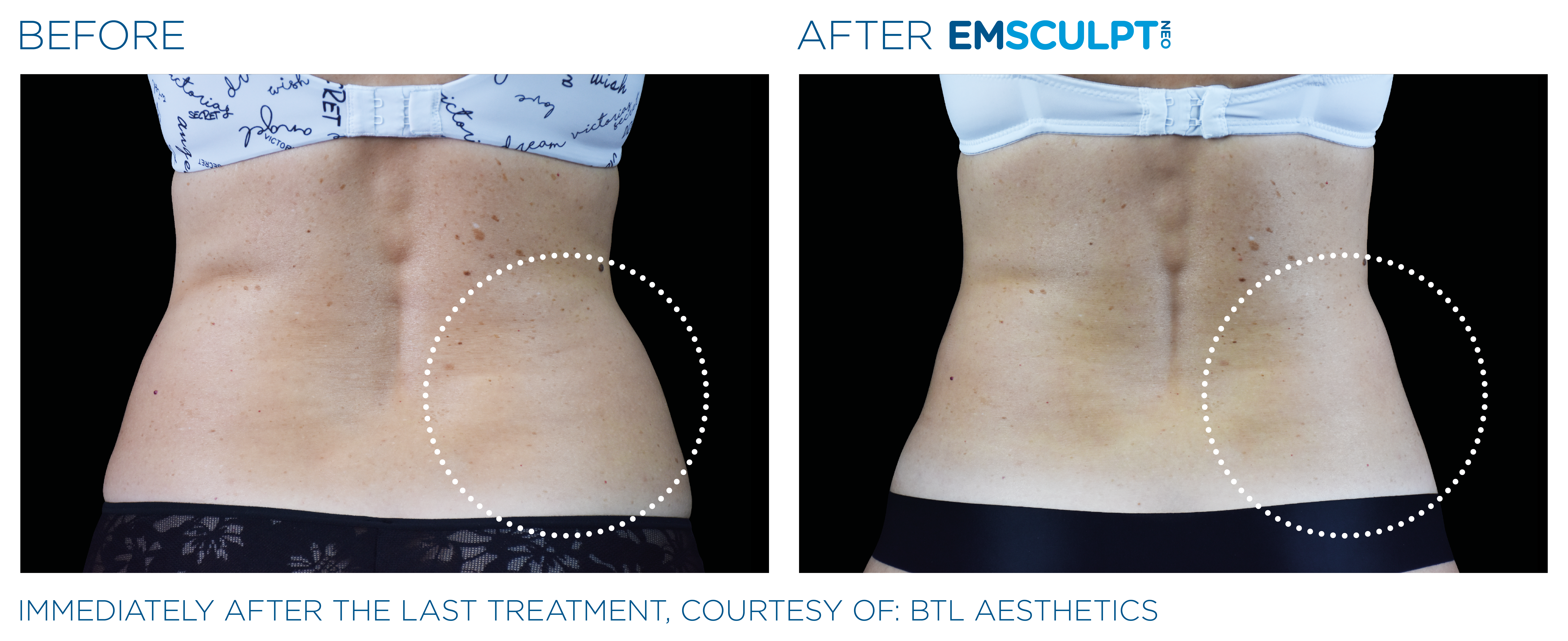 EMSculpt Neo before and after abdomen results Gastonia, NC